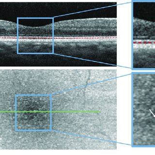 Spectral Domain Optical Coherence Tomography Sd Oct B Scan A With A