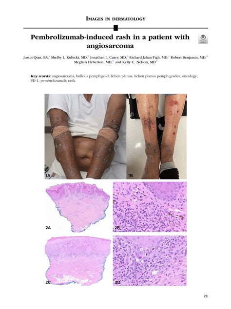 Pdf Pembrolizumab Induced Rash In A Patient With Angiosarcoma