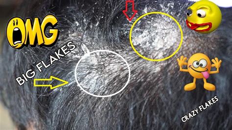 Extreme Flakes Huge Flakes On Scalp Scratching Dandruff Off Scalp