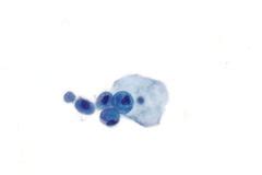 Urine cytopathology - Libre Pathology