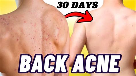 BACK ACNE TREATMENT How To Get Rid Of Back Acne SHOULDER ACNE