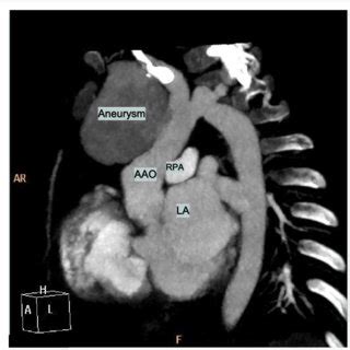 Computed Tomography Angiogram After Surgery Showed No Aneurysm Arrow