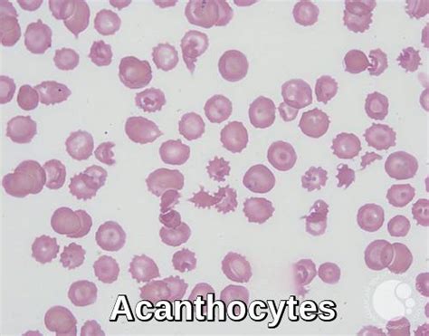 burst red blood cells smear