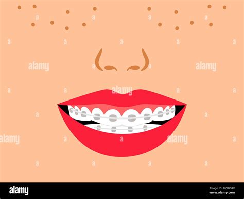 Fix Brackets Stock Vector Images Alamy