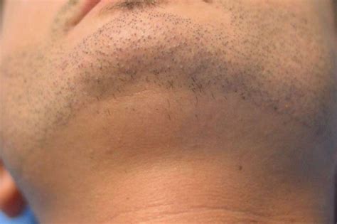 Alopecia Barbae Causes