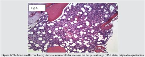 Figure 5 From A Rare Case Of Hemophagocytic Lymphohistiocytosis In A