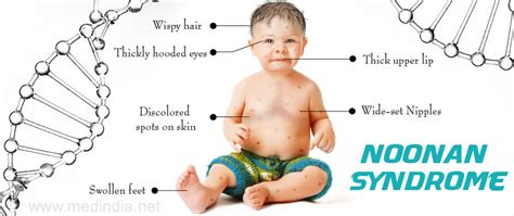 Noonan Syndrome Symptoms Causes Treatment More Medico
