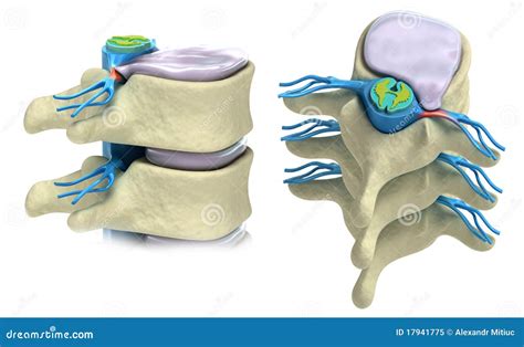 Prolapsus De Disque Intervertébral Illustration Stock Illustration Du