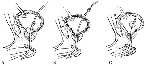 Primary Realignment Of Posterior Urethral Rupture A A F Foley