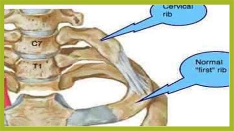 Cervical Rib