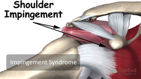 Shoulder Exam Tutorial Stanford Medicine 25 Stanford Medicine