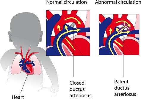 Patent Ductus Arteriosus Pda Symptoms And Risk Factors Dr Raghu