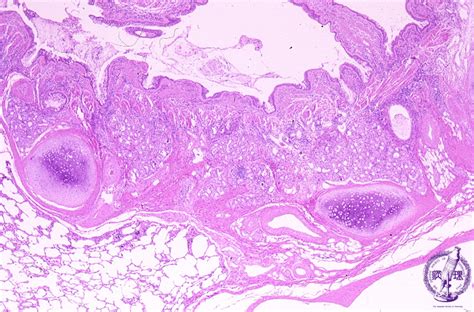 5 Lung Pleura 6 Bronchial Asthma Pathology Core Pictures