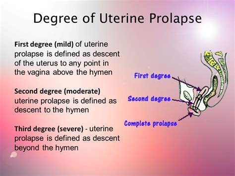 Uterine Prolapse Uterine Prolapse Dropped Uterus Is A Condition In Which A Womans Uterus