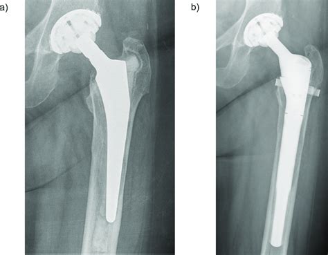 Pre And Postoperative Radiographs A Cemented Primary Tha With Aseptic Download Scientific