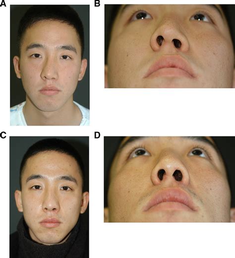 Correction Of Secondary Unilateral Cleft Lip Nasal Deformity In Adults Using Lower Lateral