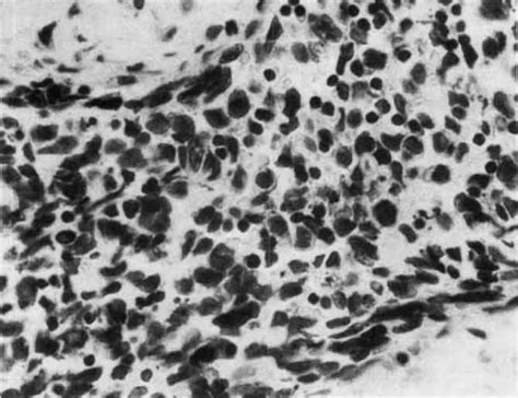 The Biopsy Of A Cervical Lymph Node From The Fourth Case Shows Download Scientific Diagram