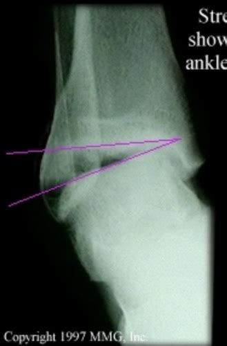 MSK Exam 3 Ortho Foot And Ankle Flashcards Quizlet