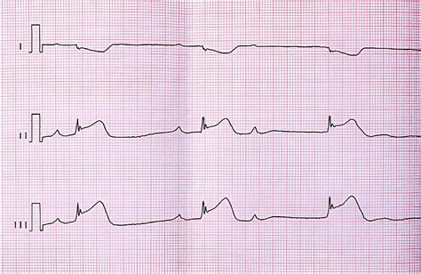 A Guide to Identifying and Treating First-Degree AV Block