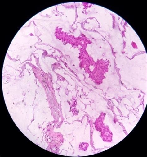 Mucinous Adenocarcinoma Of Breast A X View Of Rapid H E Stained