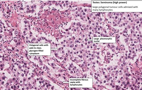 Testis Seminoma Nus Pathweb Nus Pathweb