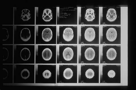 Sex Differences In The Brain And The Mind