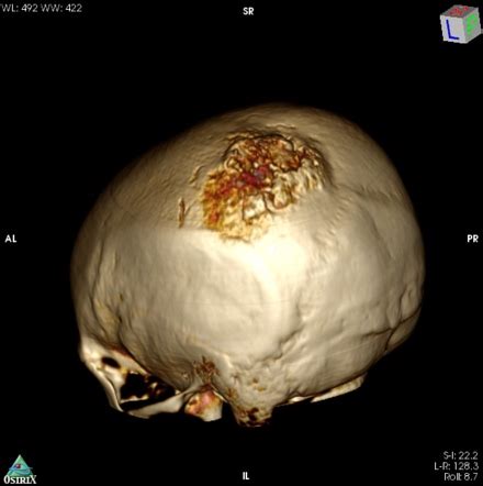 Extra Axial Tumor With Extension Through The Skull Atypical Meningioma