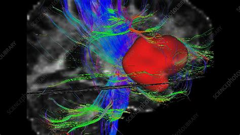 Brain tumour, DTI MRI scan - Stock Video Clip - K003/9466 - Science Photo Library