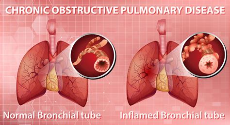 Chronic Obstructive Pulmonary Disease 1590694 Vector Art At Vecteezy