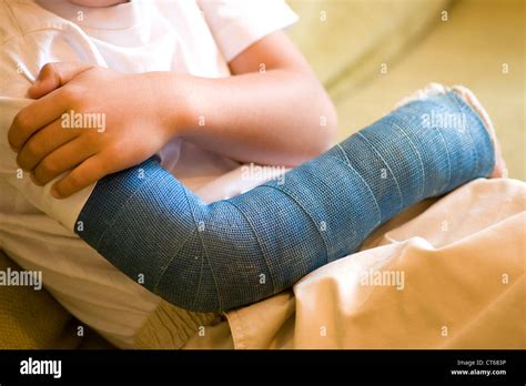 Both Arms Casts High Resolution Stock Photography And Images Alamy