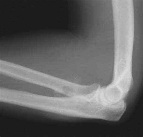 Heterotopic Ossification After A Two Incision Distal Biceps Repair Download Scientific Diagram