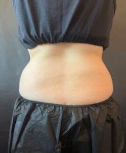 Coolsculpting For Love Handles Before And After