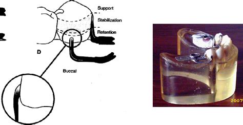 Figure From Rpi And Rpl Clasp Masticatory Load Distribution In Lower