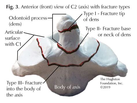 Odontoid Fractures Hughston Clinic