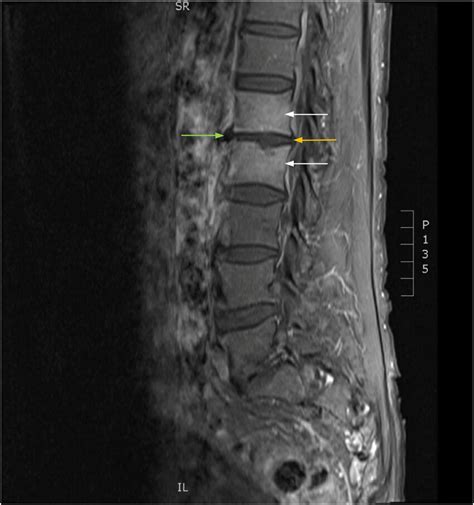 Lumbosacral Magnetic Resonance Imaging With Multiple Foci Depicting