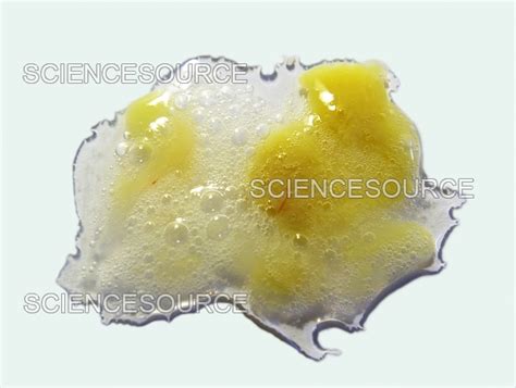 Yellow Sputum | Stock Image - Science Source Images