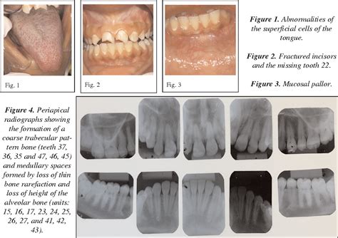 Figure From Oral Considerations In The Management Of Sickle Cell