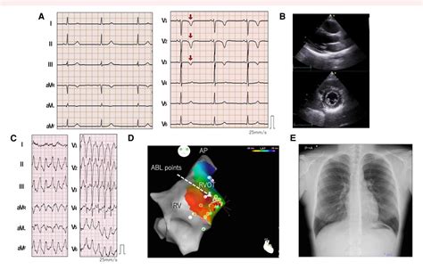 Figure 2 From Arrhythmogenic Right Ventricular Cardiomyopathy With Plakophilin 2 Genetic Variant