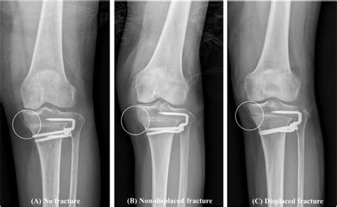 Medial Cortical Fractures In Computer Assisted Closing Wedge High