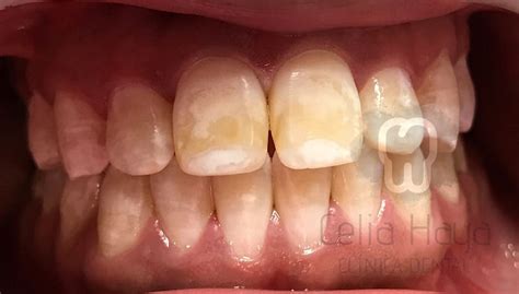 Blanqueamiento Dental Mito O Realidad Cl Nica Dental Celia Haya