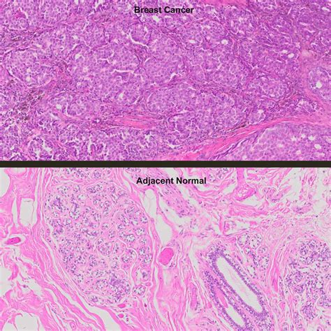 Human Breast Cancer With Er Pr Her P Normal Matched