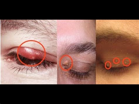 Pimples Or Bumps On Eyelids Causes And Treatments YouTube