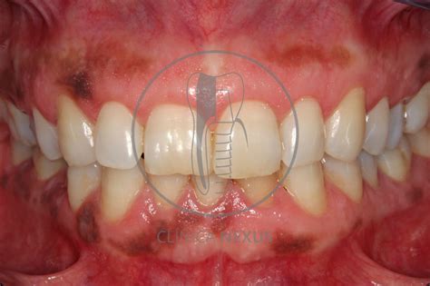 Tratamiento De Melanosis Gingival Manchas Oscuras En La Enc A