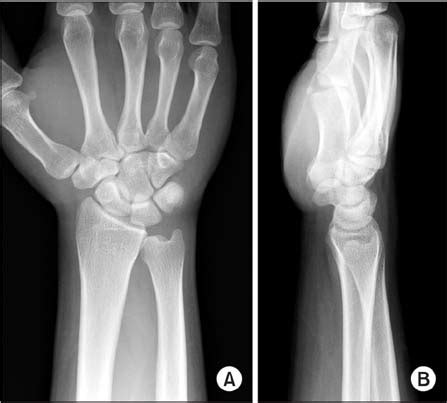 Styloid Process X Ray