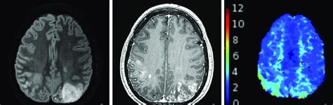 Mri Brain Mri Of The Brain With And Without Contrast Showing T2flair