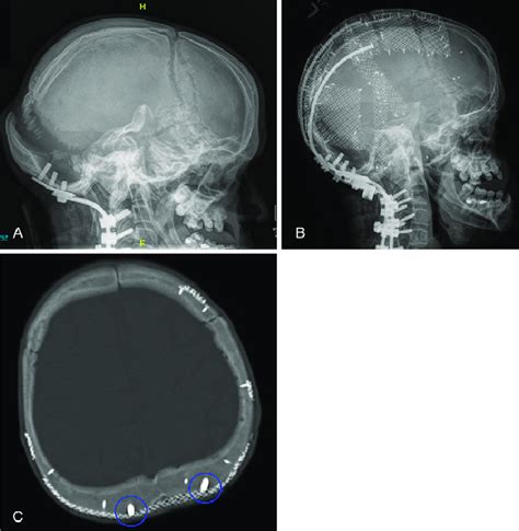 Pre A And Postoperative B Cvs Lateral Skull Radiographs A