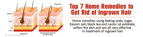 Top 7 Home Remedies to Get Rid of Ingrown Hair