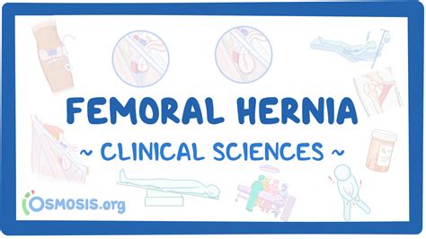 Femoral Hernias Video Meaning Osmosis