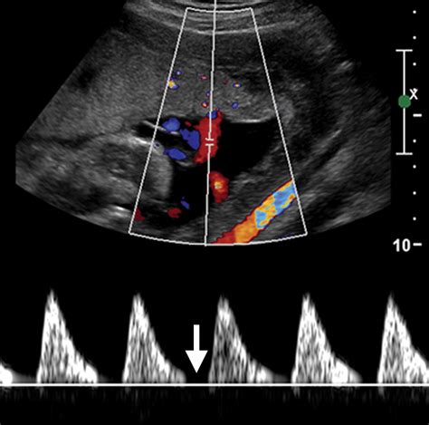 Comprehensive Imaging Review Of Abnormalities Of The Umbilical Cord