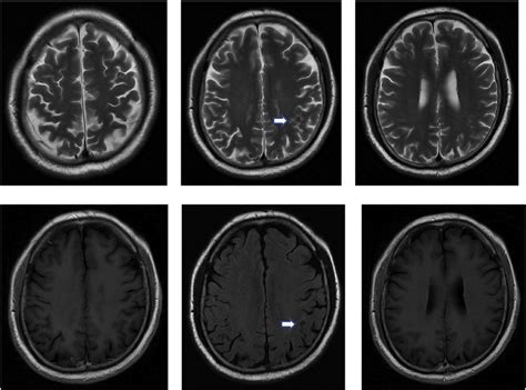 brain mri  june   bilateral cerebral cortex